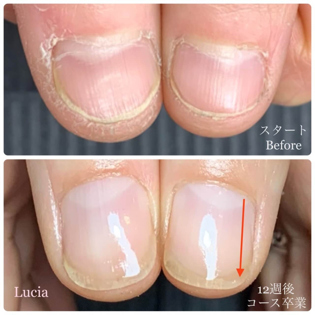 爪の変化の写真